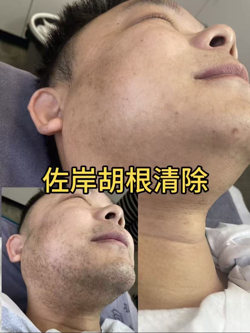 湖州脱毛