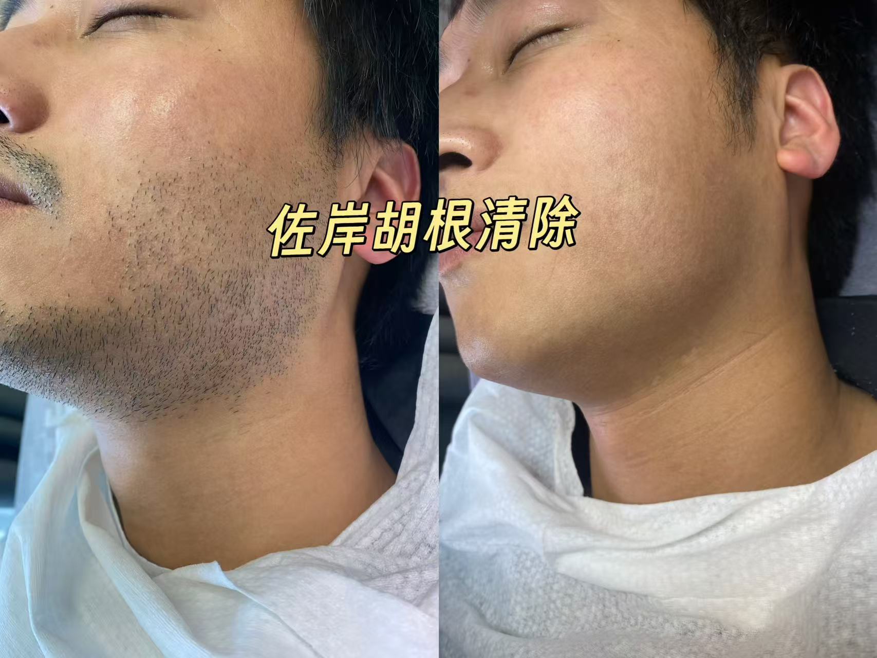 湖州脱胡子